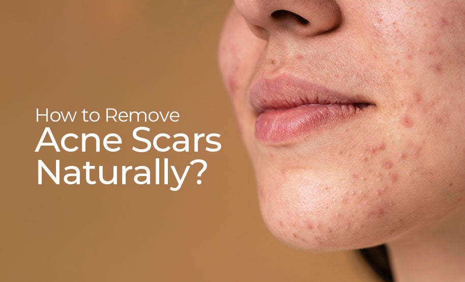 How to Remove Acne Scars Naturally?