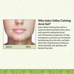 Calming Acne Gel Clarifies Skin & Soothes Acne With Seaweed Extract & Tea Tree Oil - 30ml.