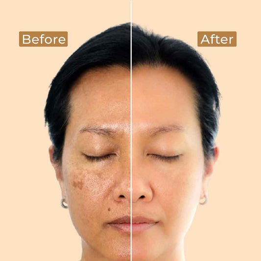 Brightening Depigmentation Gel - before and after